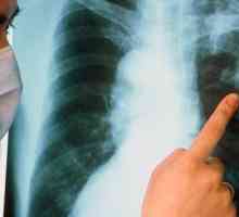 Koji je najvažniji simptom plućne tuberkuloze?