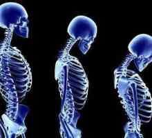 Koji liječnik liječi osteoporozu? Osteoporoza: simptomi, uzroci, liječenje i prevencija