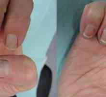Kandidijaza noktiju: simptomi, liječenje