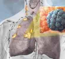 Karcinom pluća: simptomi, faze, liječenje, prognozu