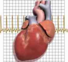 Kardioloskleroza srca: simptomi, liječenje, uzroci