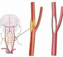 Karotidna endarterektomija: indikacije, postoperativno razdoblje, komplikacije, recenzije…