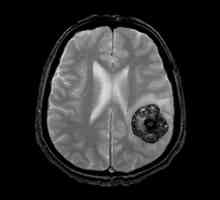 Cavernoma mozga: uzroci, simptomi, dijagnoza, metode liječenja, posljedice