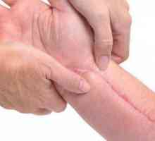 Keloidni i hipertrofični ožiljci: opis, vrste, uzroci i liječenje