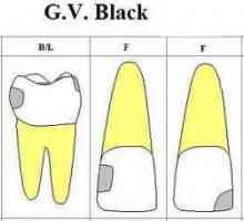 Crna klasifikacija karijesnih šupljina: opis, stupanj, razred i liječenje