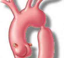 Što je s koartmiranjem aorte? Koagtiranje aorte u djece
