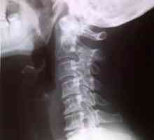 Žbica u grlu s cervikalnim osteokondroza: simptomi, liječenje