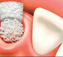 Plastična operacija kostiju za implantaciju zuba: recenzije