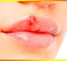 Puziteljski herpes, ili kako tretira hladnoću na usnama