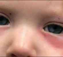 Crvenilo pod očima djeteta: uzroci i liječenje