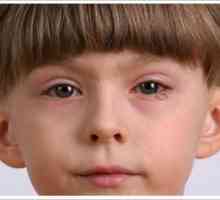Crvene oči u djetetu: uzroci, liječenje i prevencija