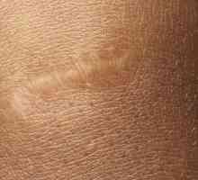 Krema od ožiljaka i ožiljaka na licu: recenzije o proizvođačima i savjetima liječnika