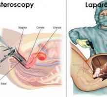 Laparoskopija i histeroskopija: indikacije, recenzije, što je bolje