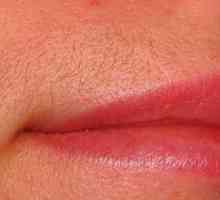 Laserska epilacija gornje usne: učinkovit postupak u borbi protiv dosadnih dlačica