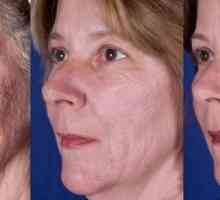 Poliranje lica s lica: indikacije i kontraindikacije, njegu nakon postupka, plus i minusa, recenzije