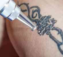 Lasersko uklanjanje tetovaža - opis postupka, značajke i recenzije