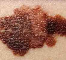Liječenje melanomom: osnovne metode
