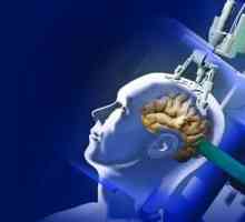 Liječenje tumora mozga u Izraelu - inovativne metode