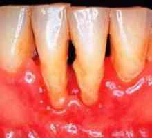 Liječenje parodontitisa s narodnim metodama