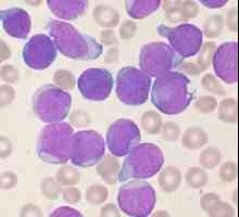 Leukemija: što je to i postoji li šansa za spasenje?