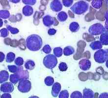 Leukocitoza - kakva je to bolest?
