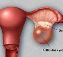 Burirana cista jajnika: simptomi, metode liječenja, kirurgija, posljedice