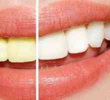 Najbolji gelovi za izbjeljivanje zubi: recenzije proizvođača, preporuke za upotrebu