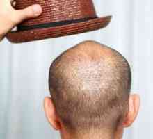 Najbolje sredstvo za gubitak kose: losioni. Pregled, proizvođači, sastav i recenzije
