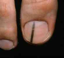 Melanom nokta: znakovi i liječenje