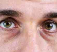 Torbe pod očima muškaraca: uzrok i liječenje