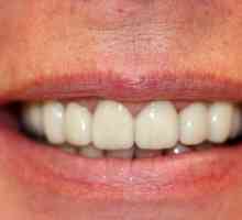 Metalni keramički zubi. Protetski stomatologija: kermeti