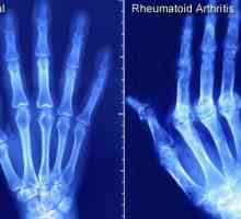 "Metotreksat" za reumatoidni artritis: recenzije. Upute za uporabu, opis pripreme