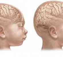 Microcefalija mozga kod djece: simptomi. Microcefalija je ...