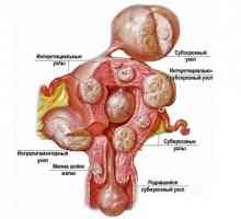 Cervikalna mioma: znakovi, uzroci i karakteristike liječenja