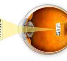 Mikaopija oka: simptomi, uzroci, dijagnoza i liječenje