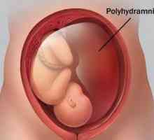 Polyhydramnios tijekom trudnoće: uzroci i posljedice. Učinak polihidramina na rad