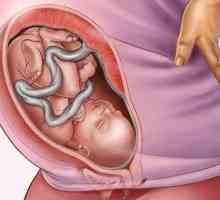 Polyhydramnios tijekom trudnoće: uzroci, liječenje, moguće posljedice za dijete