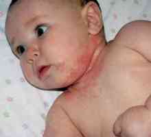 Mokro dermatitis kod djece: foto i liječenje
