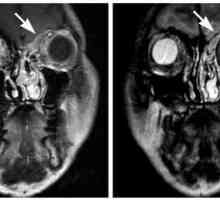 MRI sinusa nosa: gdje činiti ono što pokazuje? Tomografija sinusa nosa
