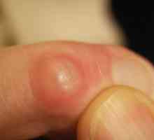 Rast na prstu: što može biti? Zašto se rastanak pojavljuje na prstima ruku?