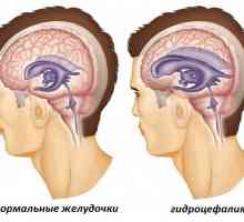 Vanjska hidrocefalus mozga kod odraslih: znakovi i liječenje