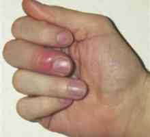 Dumps prst na ruku: uzroci, simptomi i metoda liječenja