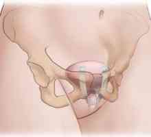 Inkontinencija urina na kašalj: uzroci i metode liječenja