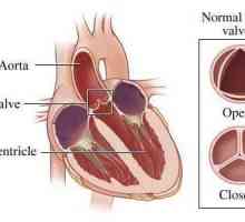 Nedostatak aortalnog ventila 1, 2, 3 stupnja: znakovi, simptomi, dijagnoza, liječenje