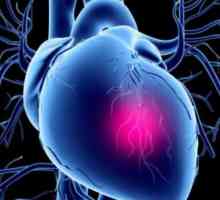 Hitna skrb za kardiogeni šok: algoritam djelovanja. Hitna brigada za reanimaciju