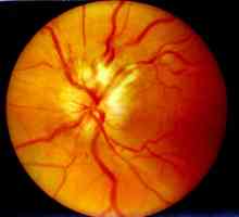 Optički neuritis: uzroci, simptomi, dijagnoza i značajke liječenja