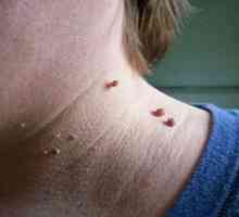 Neoplazije na koži: vrste, uzroci razvoja, dijagnoze, liječenja, prevencije