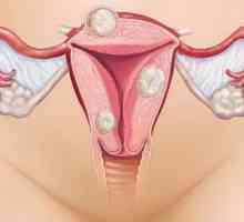 Vrlo teška bol s menstruacijom: uzroci, liječenje