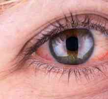Ocalin u oku - što da radimo? Prva pomoć za traumu oka