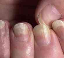 Onychomycosis - što je to? Onychomycosis of the nails: liječenje kod kuće